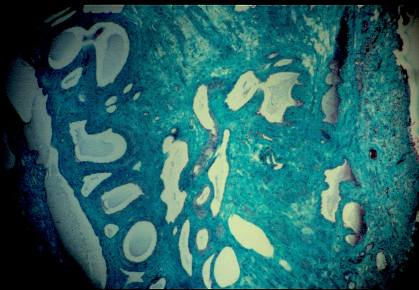 clérose histologie.